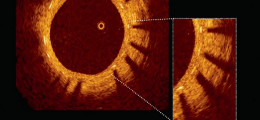 OCT – The latest imaging technology taking Angioplasty to a new level