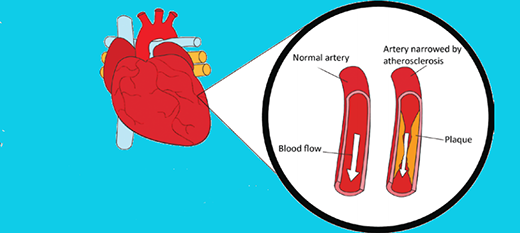The ABC of Angioplasty Arm yourself with key facts