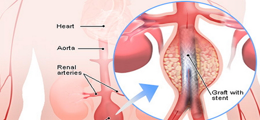 A Stent in Time – Stenting through a pinhole procedure