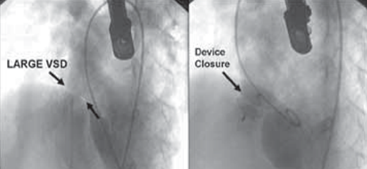 New therapies for non surgical correction of heart defects