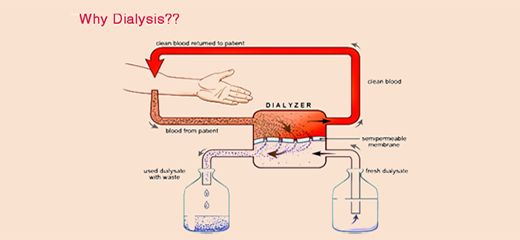 When is dialysis needed? What does dialysis do?