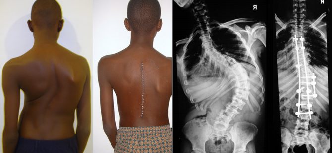 A 14yr old boy with scoliosis treated successfully at MIOT