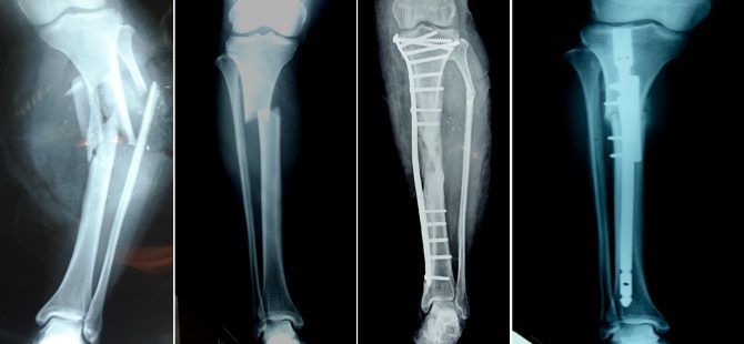 A 25yr old girl with open fracture of both legs treated successfully at MIOT