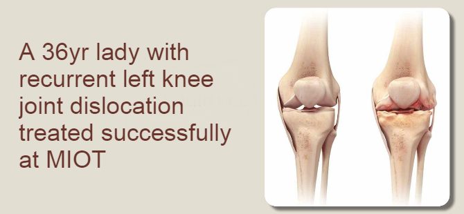 A 36yr lady with recurrent left knee joint dislocation treated successfully at MIOT