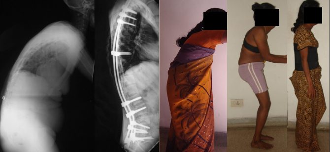 A case of Ankylosing Spondylitis suggested inoperable elsewhere, treated successfully at MIOT