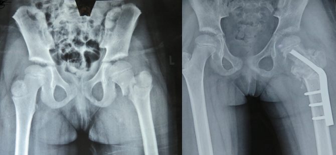 A 6yr old with Crippling Deformity treated successfully with segmental transport of bone