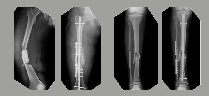 Grade III B Fracture treated successfully with Limb Reconstruction by Plate Osteosynthesis