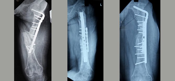 Osteogenesis Imperfecta, a bone disorder mis-treated in various other places, treated and successfully corrected