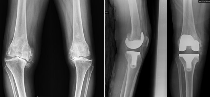 A 55yr old Lady with severe Tri-compartmental arthritis treated successfully with Total Knee Replacement