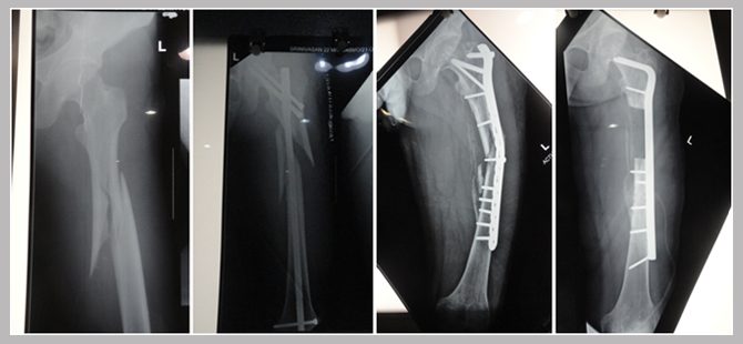 After 2 unsuccessful surgeries leading to left thigh deformity elsewhere, patient put back on his own feet at MIOT