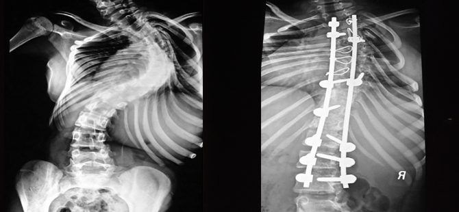 Idiopathic Scoliosis treated at MIOT