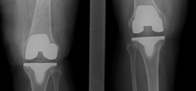 Bi-lateral Total Knee Replacement performed successfully at MIOT