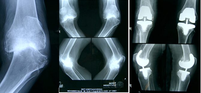 Crippled Due to Arthritis with Bone Loss
