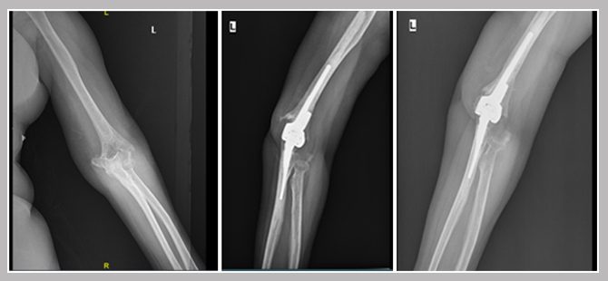 Geriatric elbow fracture treated successfully with Total Elbow Replacement