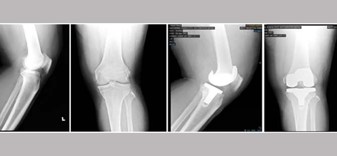 After failed attempts elsewhere to correct his limping, Mr.Marvin successfully treated with Total Knee Replacement Surgery