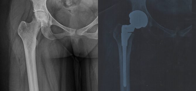 Successful Hip replacement in a patient with sickle cell Anemia