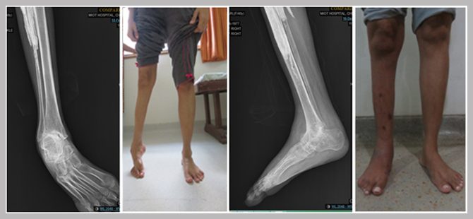 Severe Deformity of Foot and Ankle corrected successfully with Ílizarov’s Ring external fixator