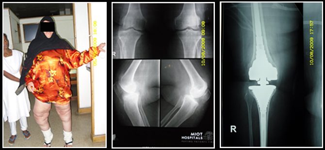 Total Knee Replacement in Morbid Obesity