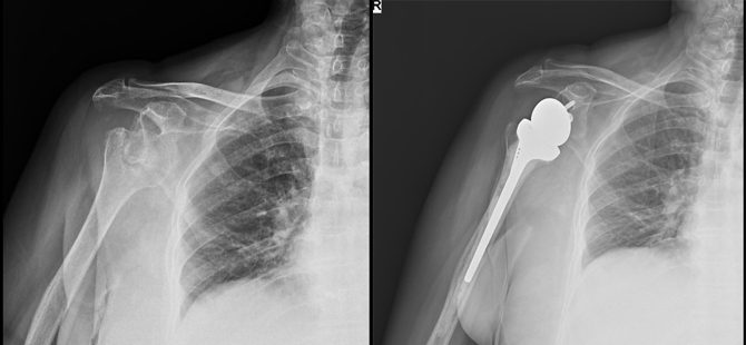 Total Shoulder Arthroplasty performed successfully for a 56yr old lady