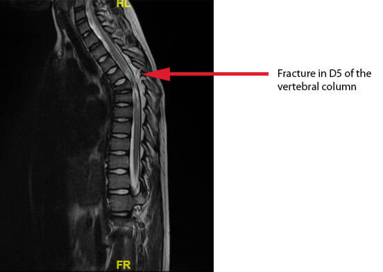 eric-spinal-cord-mri-D5-fracture