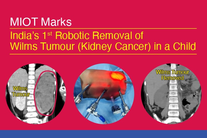 India’s 1<sup>st</sup> Robotic Removal of Wilms Tumour (Kidney Cancer) in a Child