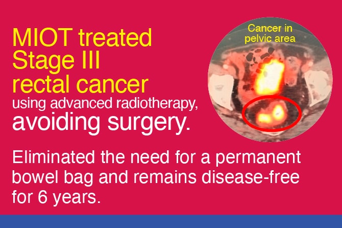 MIOT treated Stage III Rectal Cancer using advanced radiotherapy, avoiding surgery.