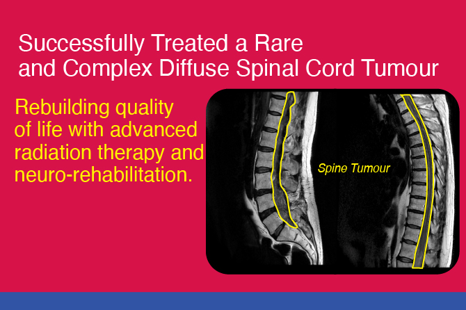 Restoring Mobility and Quality of Life through Advanced Radiation Therapy and Neurorehabilitation
